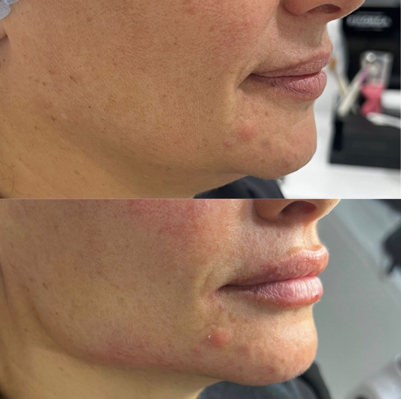 Non-Surgical Lifting