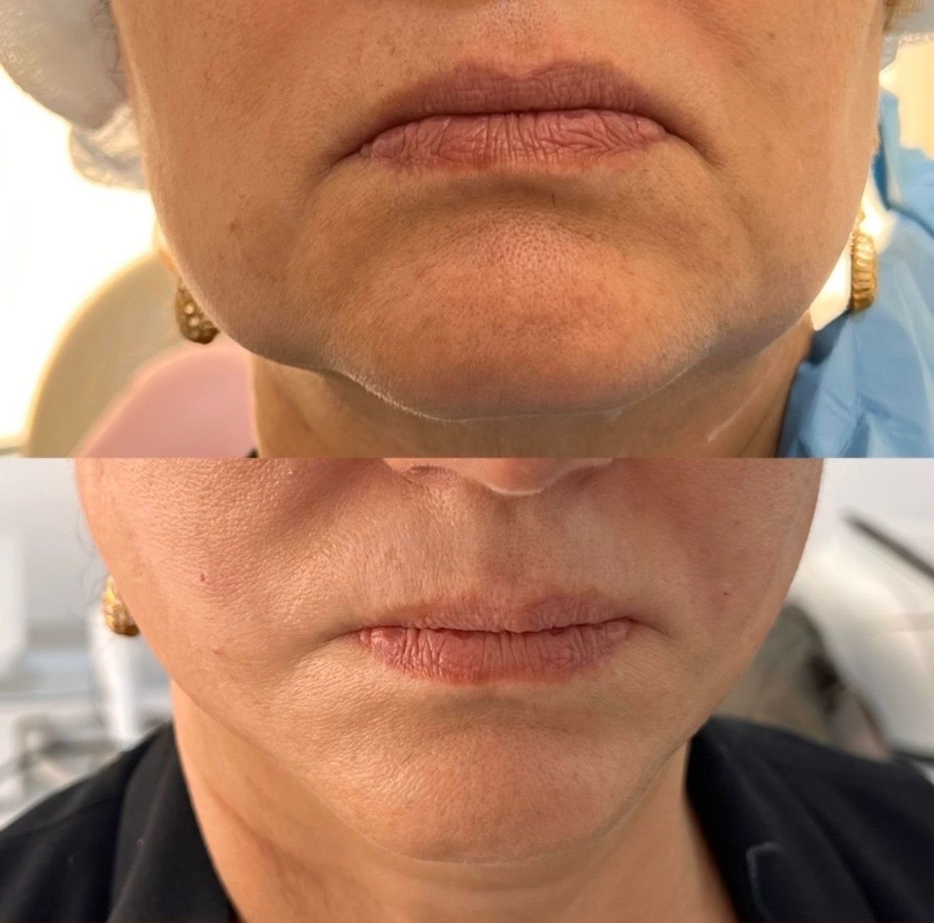 Non-Surgical Lifting