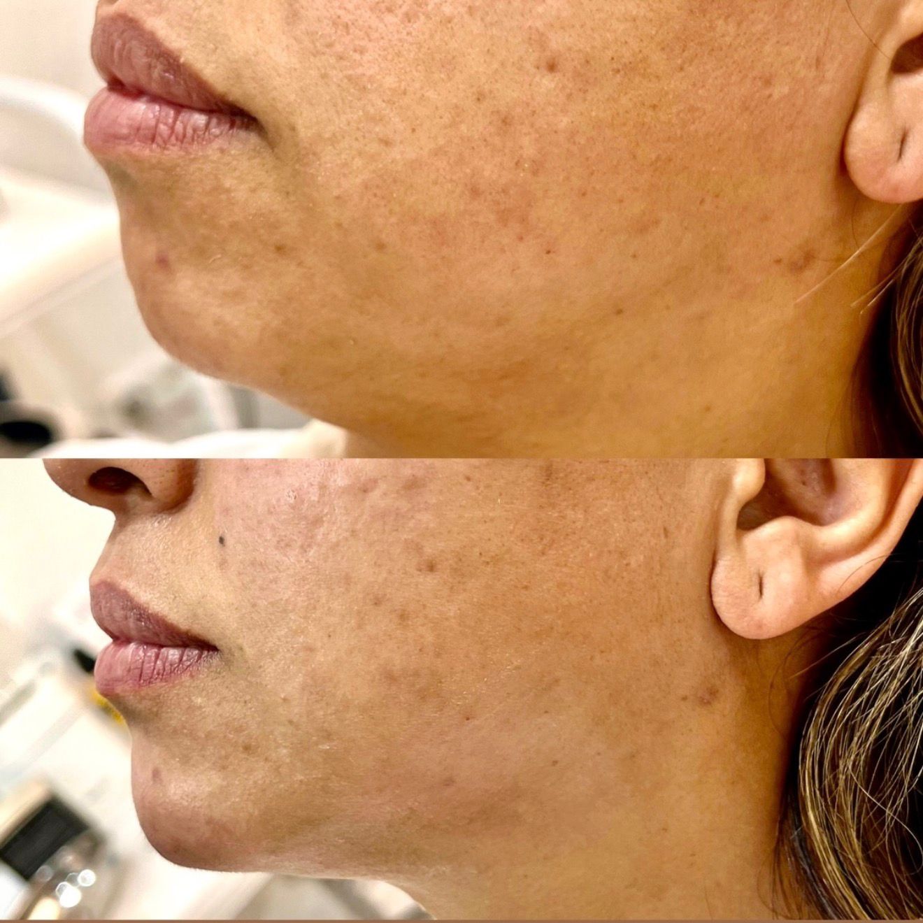 Non-Surgical Lifting
