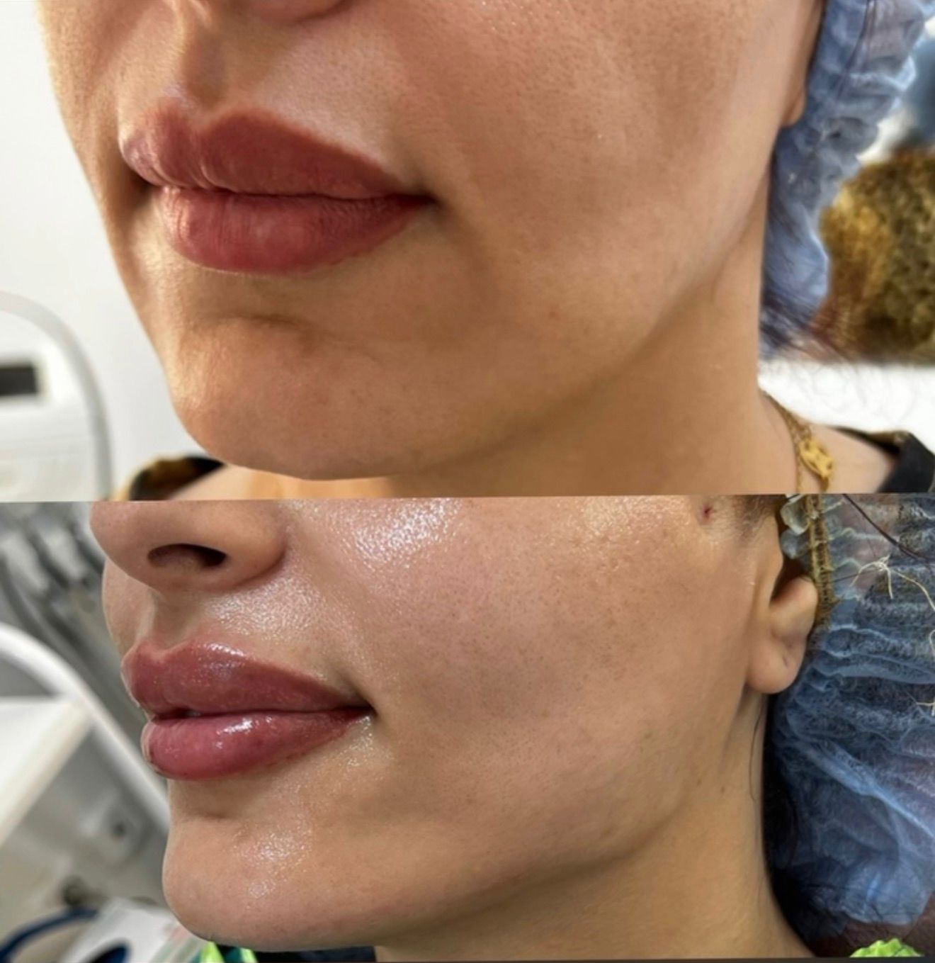 Non-Surgical Lifting