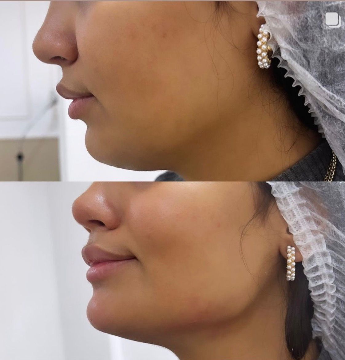 Non-Surgical Lifting
