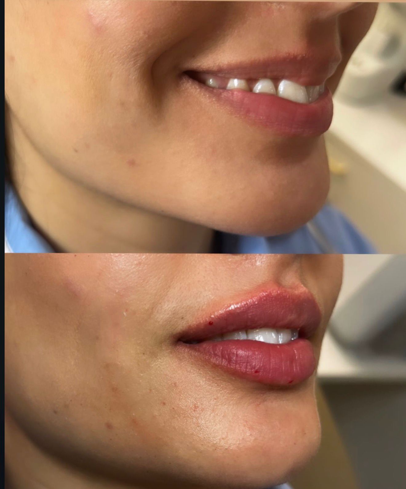 Lip Augmentation
