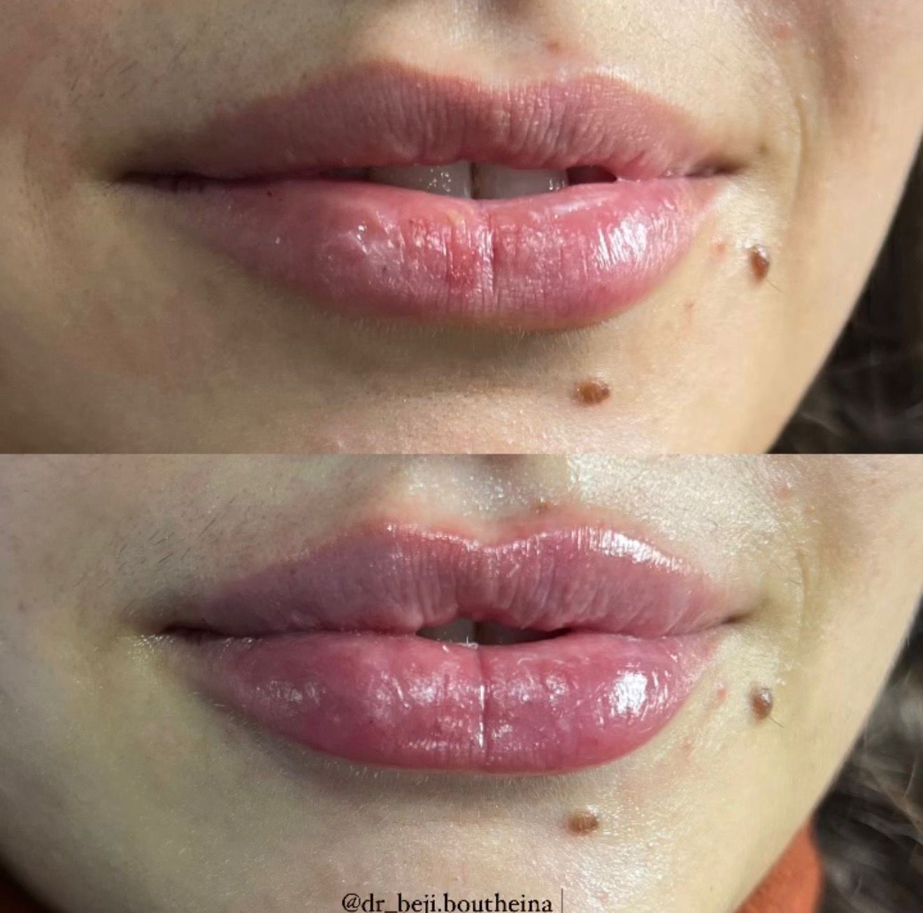 Lip Augmentation
