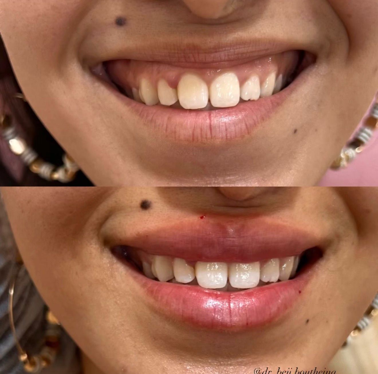 Lip Augmentation