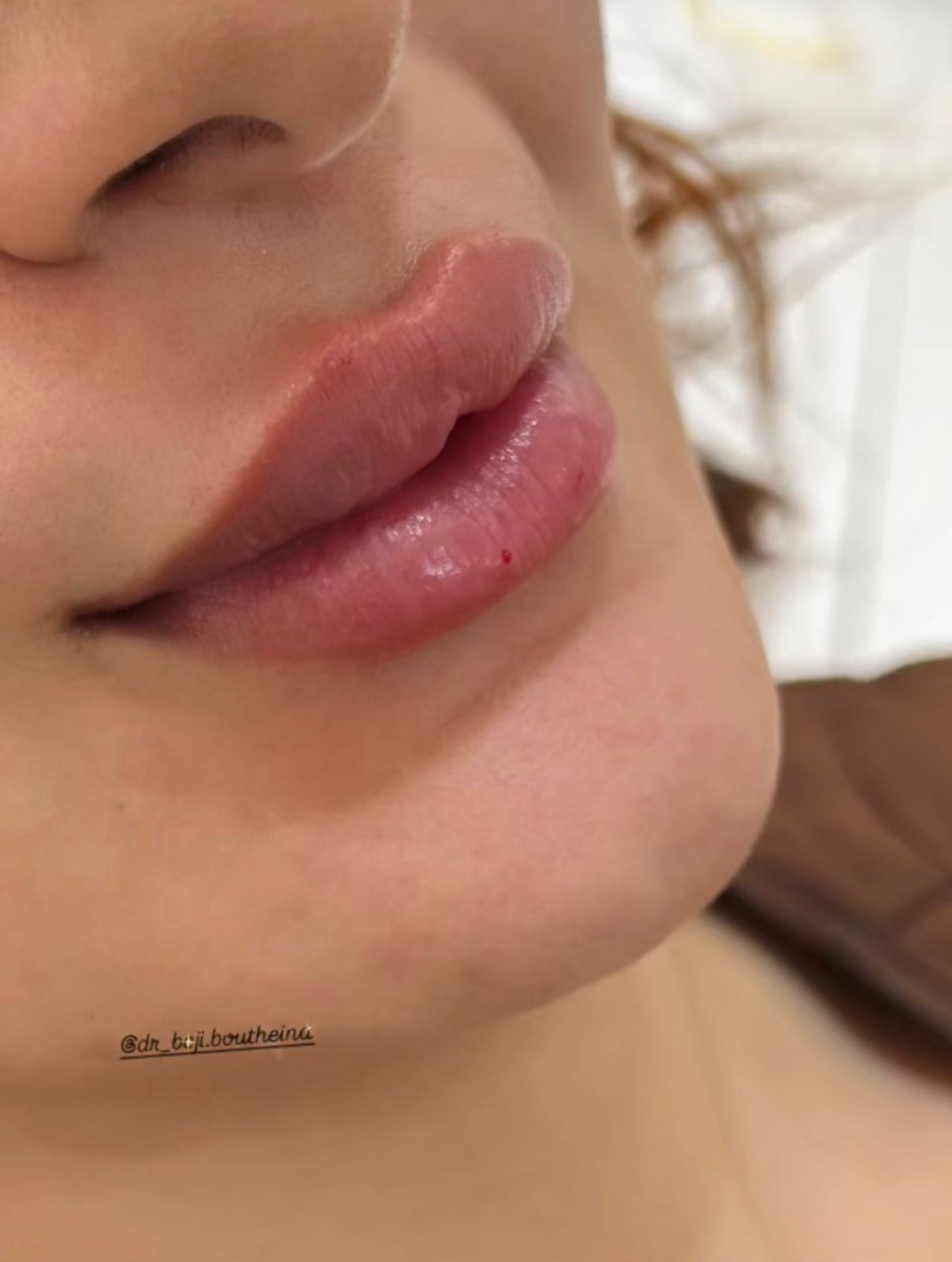 Lip Augmentation