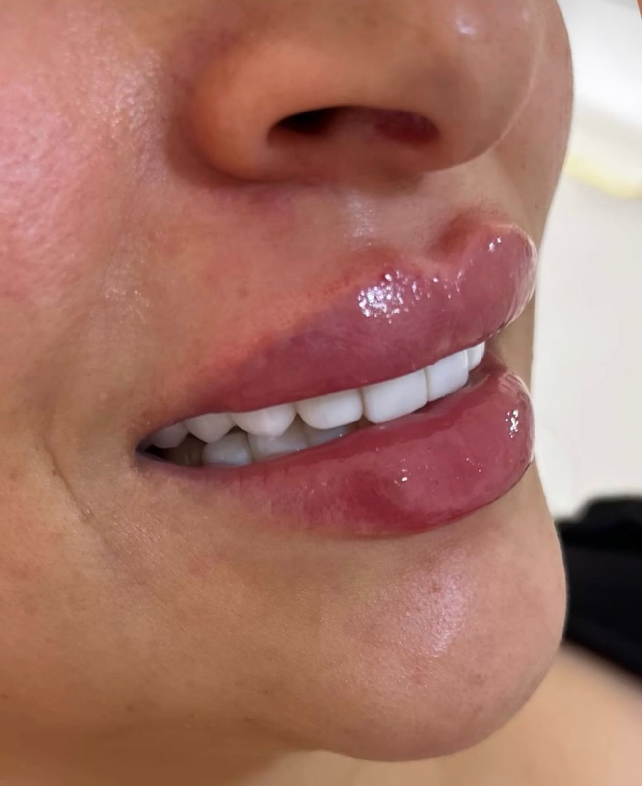 Lip Augmentation