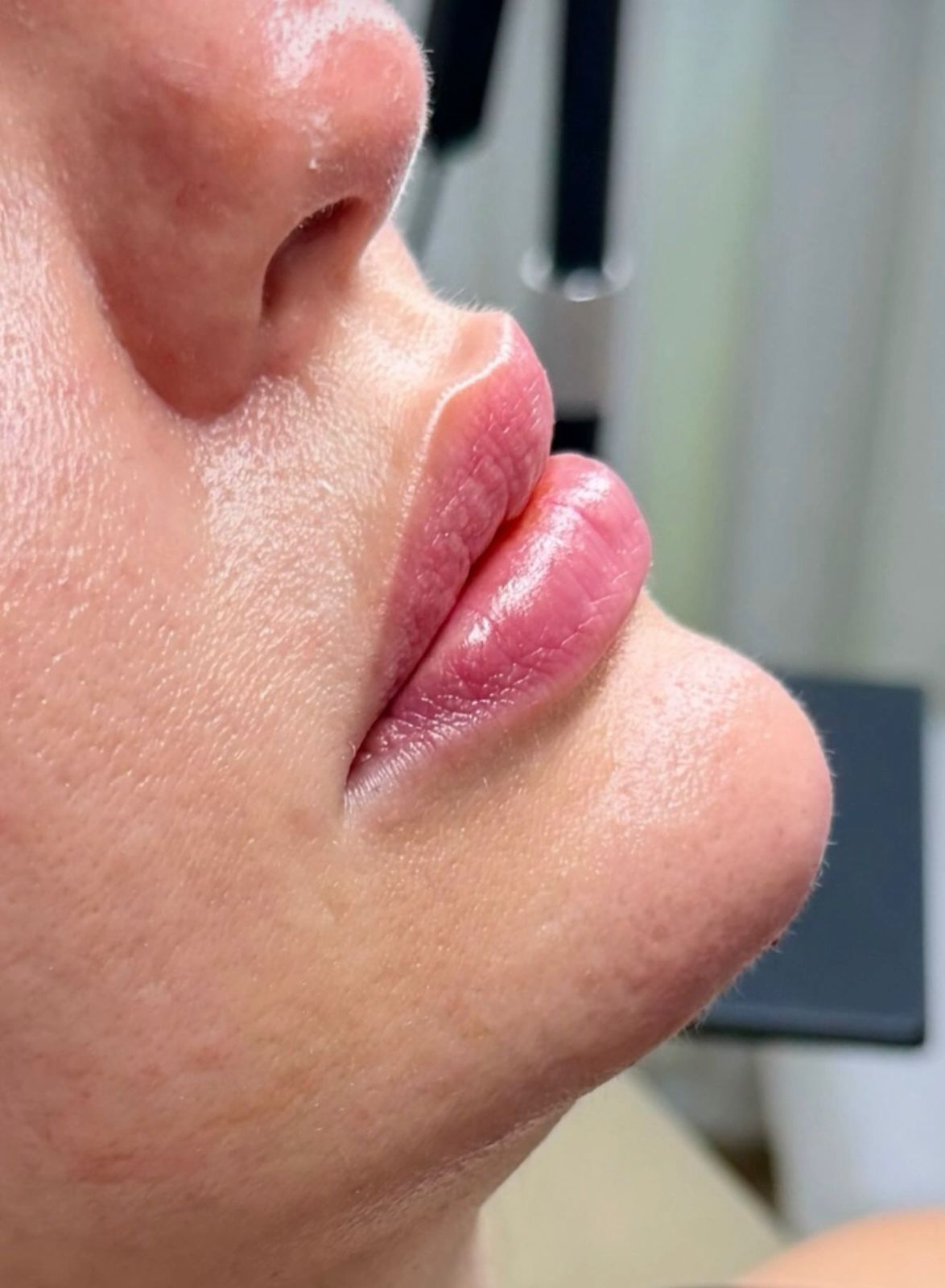 Lip Augmentation