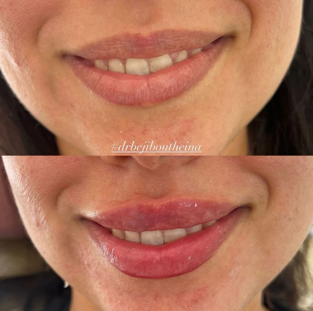Lip Augmentation
