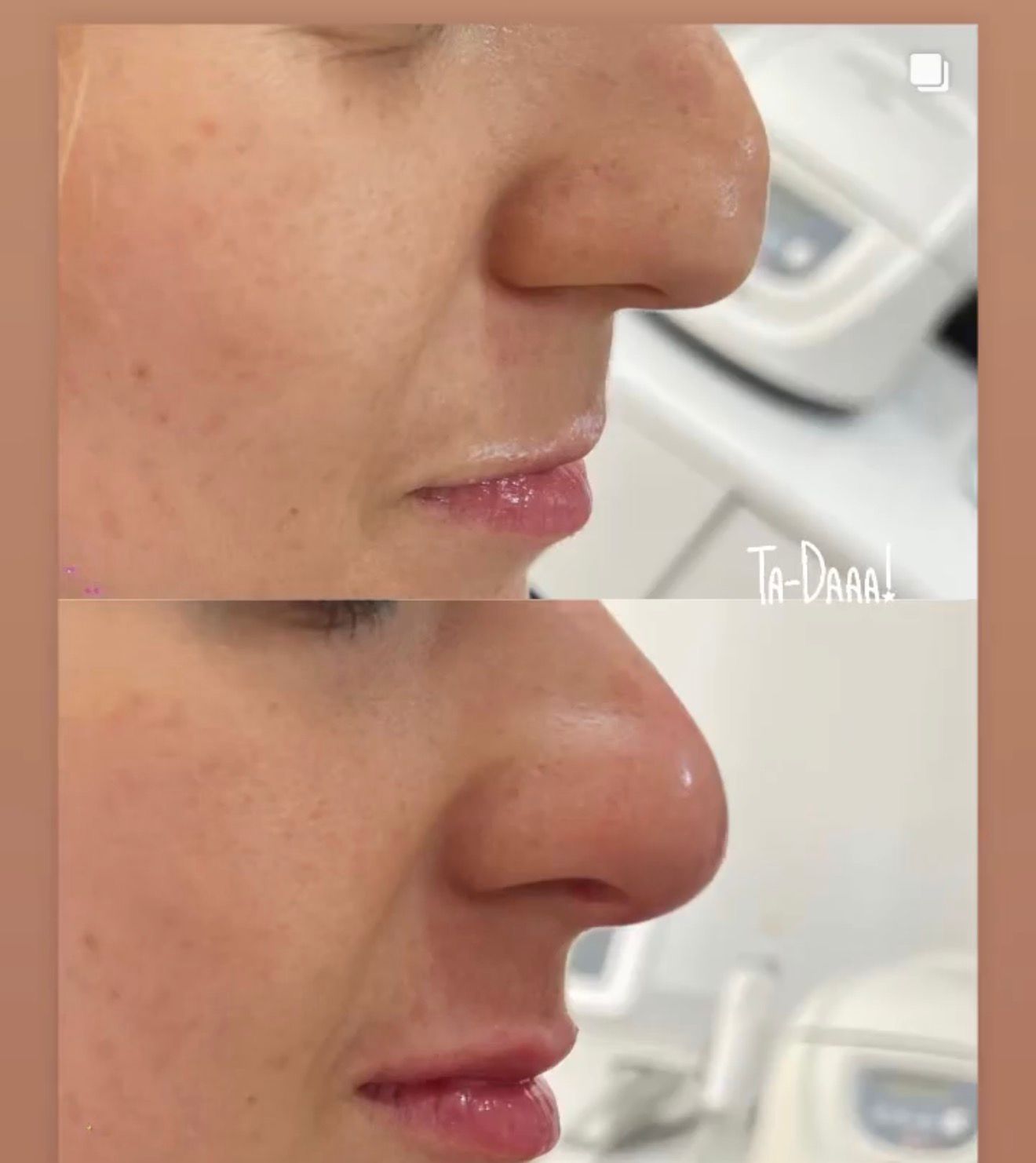 Medical Rhinoplasty