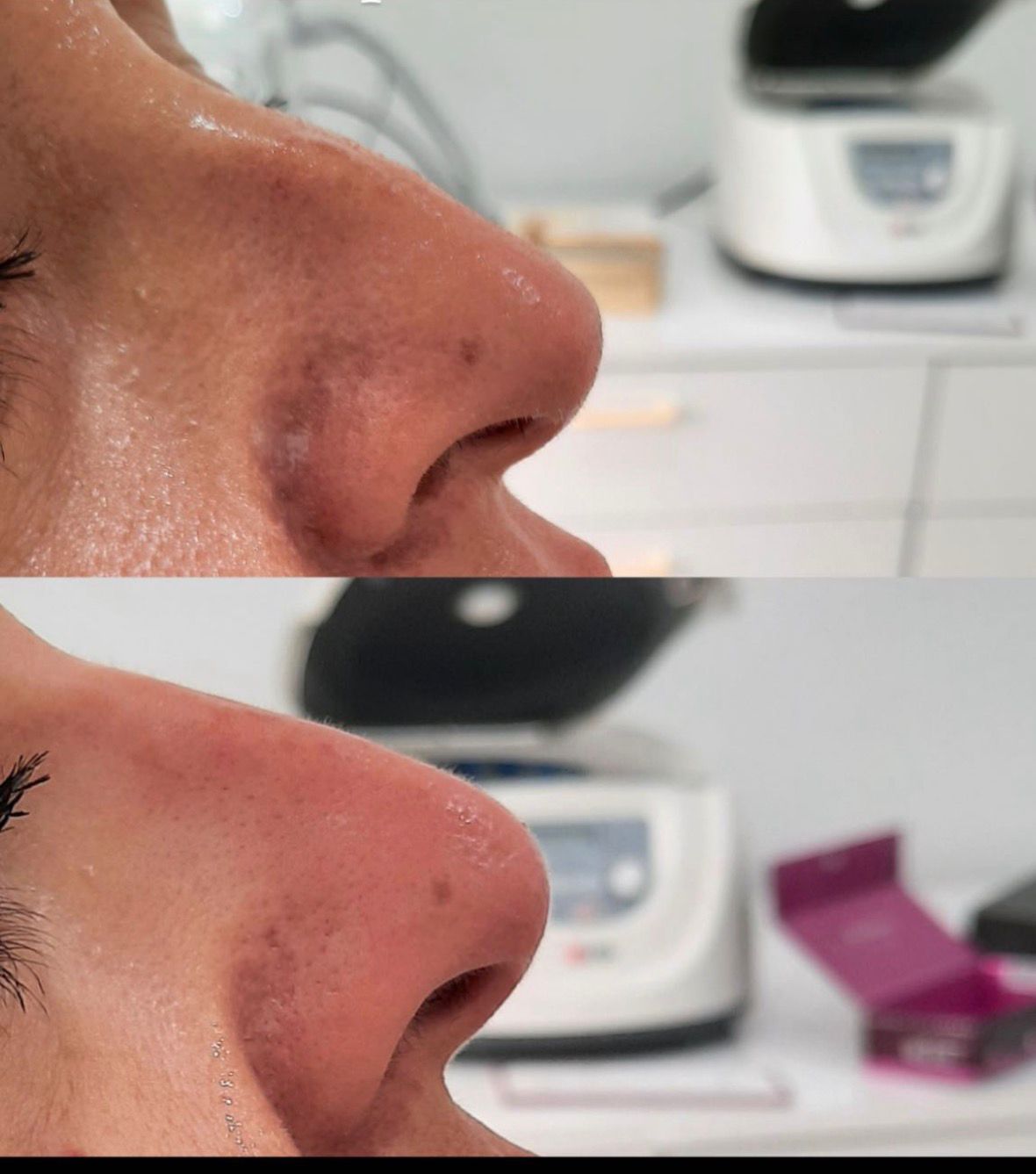 Medical Rhinoplasty
