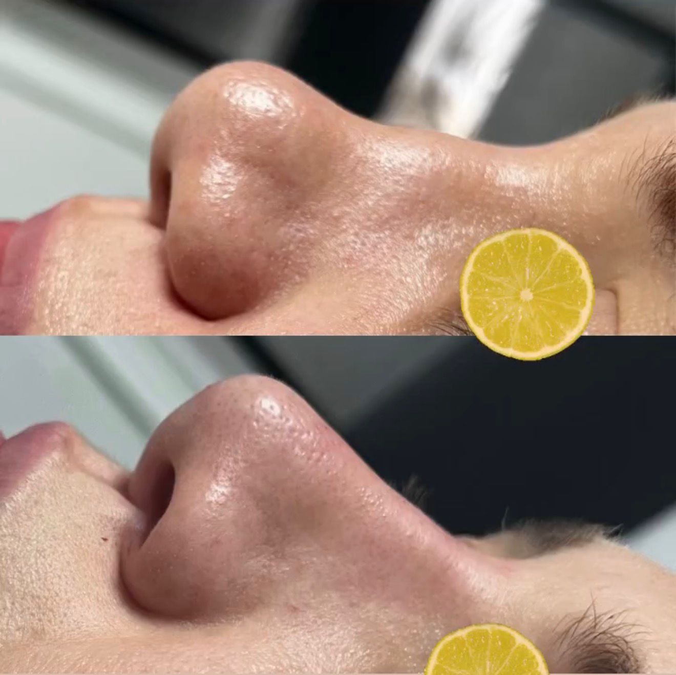 Medical Rhinoplasty