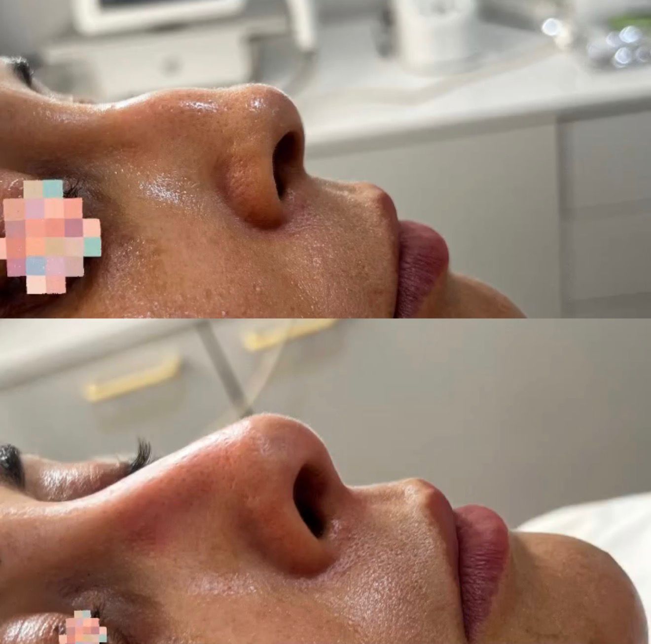 Medical Rhinoplasty