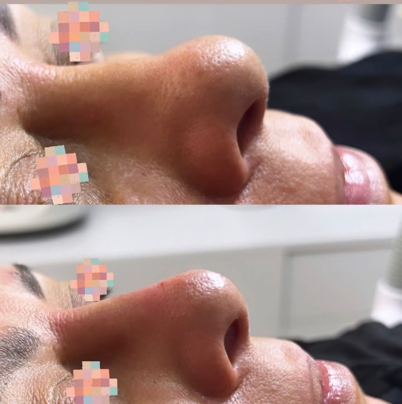 Medical Rhinoplasty