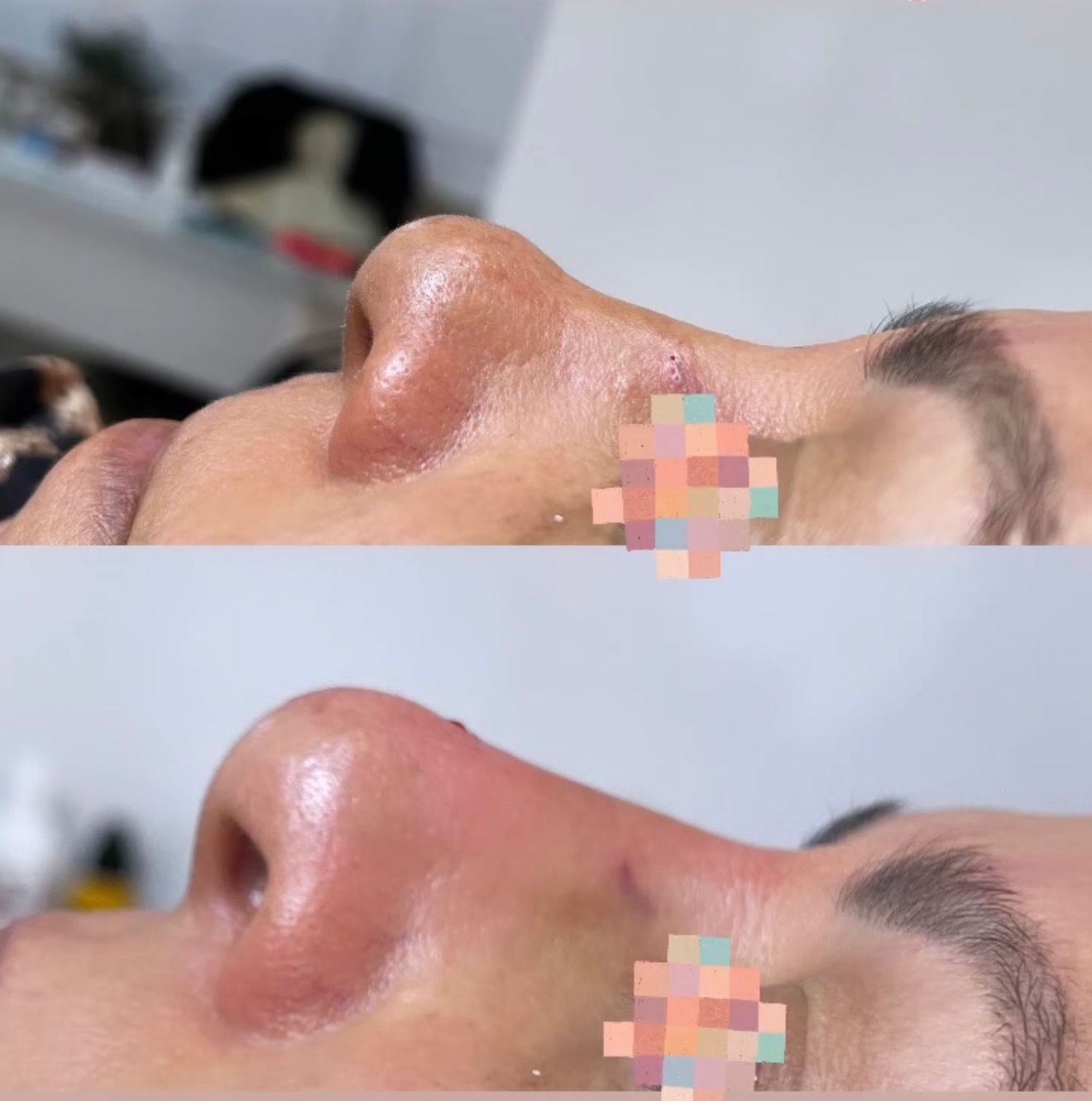 Medical Rhinoplasty