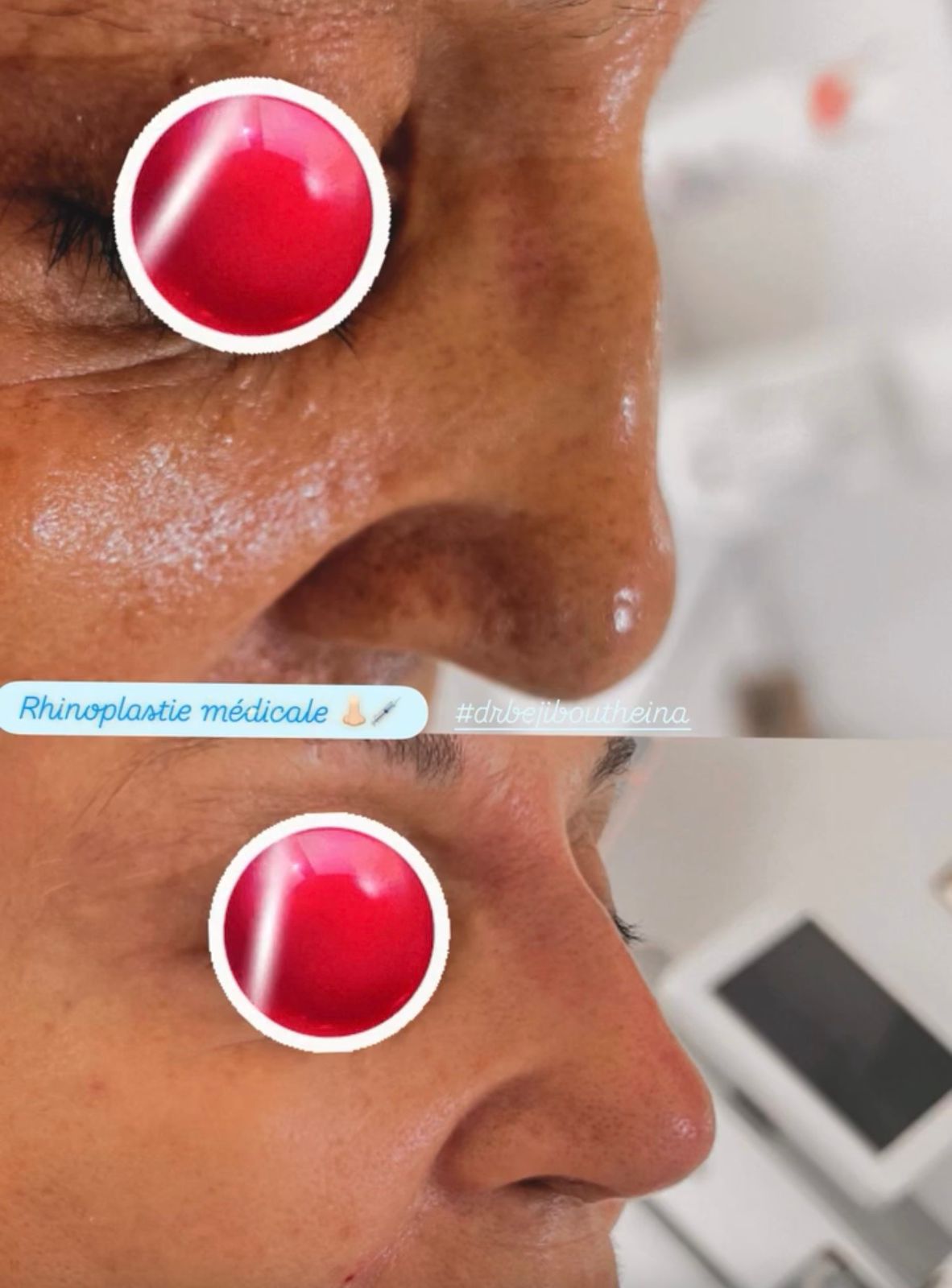 Medical Rhinoplasty